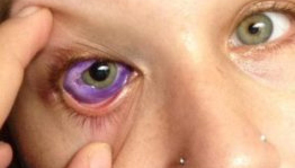 Una modelo se tatúa el ojo y ahora lucha por no perder la vista